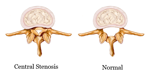 Lumbar Spinal Stenosis - OrthoInfo - AAOS